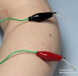 electroacupuncture Process