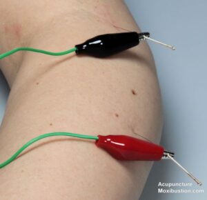 electroacupuncture Process01