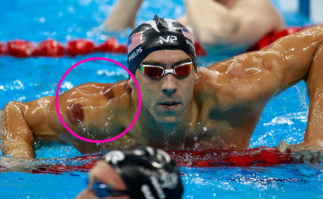 Berkeley Accupunture Phelps with cupping marks