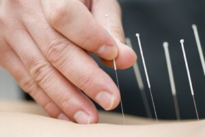 Berkeley Accupunture treatment with needles does not hurt.