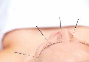 Acupuncture For Anxiety In Berkeley
