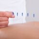 Acupuncture for Fertility
